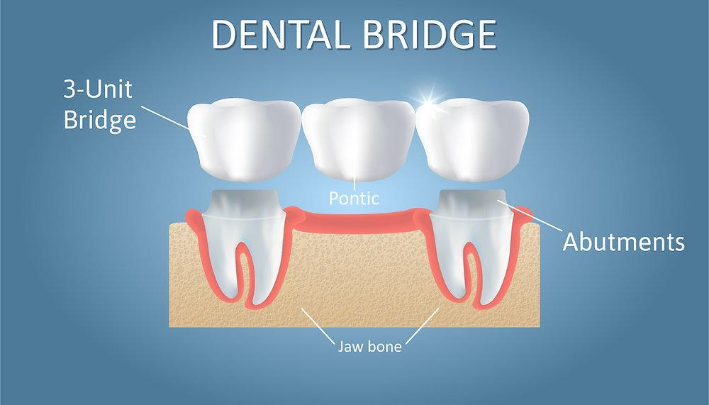 dental veneers in pragathi nagar